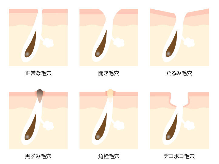 毛穴のケア【クリニックだからできること】